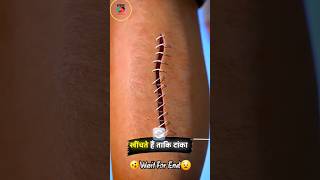 How Stitches Work  टांके कैसे काम करते हैं 😧 shorts stitches work zackdfilms doctor [upl. by Blanca]