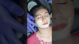 COSMELAN PEEL to treat hyperpigmentation [upl. by Latreese]