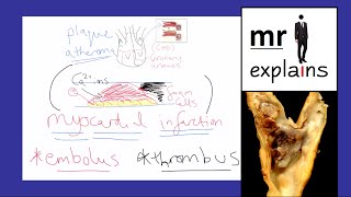 mr i explains How atheroma fat plaques form and lead to Myocardial Infarctions heart attacks [upl. by Enylekcaj]