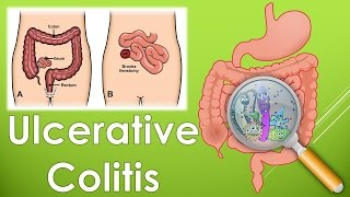 What is an Ulcerative Colitis What are the symptoms of Ulcerative Colitis [upl. by Omsare895]