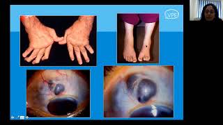 Scleritis Diagnosis and Management [upl. by Suzi]