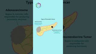 Types of Pancreatic Cancer Explained  Knowing the Different Forms  Dr Vivek Sukumar [upl. by Nickie841]