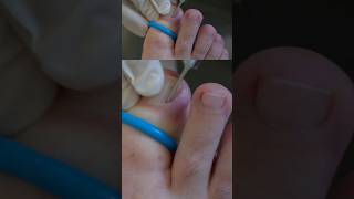 This is how thwaites nippers are used in nail surgery [upl. by Marceau10]