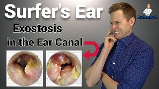 CRAZY Growth in the Ear Canal  Surfers Ear due to Exostosis [upl. by Adnahsor]