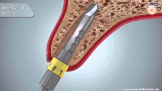 CTECH EL Immediate Implant placement and loading protocol [upl. by Nagrom]