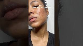 Does Tretinoin Really Improve Skin and Fight Acne tretinoincream acnetreatment acnemarks [upl. by Aihtniroc135]