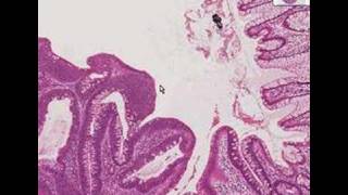 Histopathology ColonTubular adenoma [upl. by Ecienal]