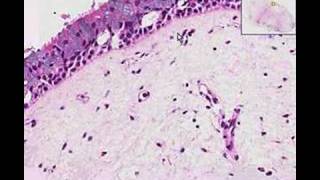 Histopathology Nose Nasal polyp [upl. by Stoddart]