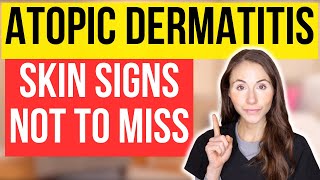 Dont Miss These 15 Signs Of Atopic Dermatitis [upl. by Kaspar]