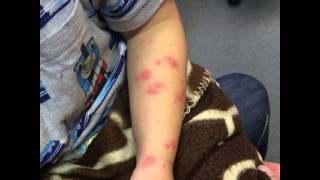 erythema multiforme caused by epilepsy med lamictal watch it progress [upl. by Nyltak]