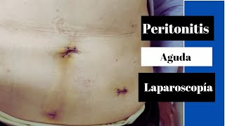 Peritonitis Aguda [upl. by Meredi]