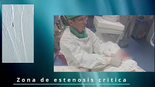 Jet stream en lesion calcificada [upl. by Margy]