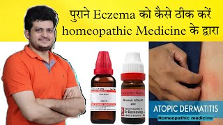 How to Cure Atopic Dermatitis  Homeopathic Medicine  full Treatment amp Precautions [upl. by Halla]