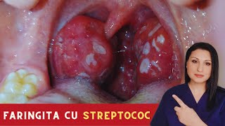 Faringita cu STREPTOCOC Tot ce trebuie sa stii [upl. by Trebmal]