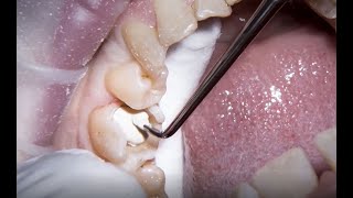 Treating secondary caries with Biodentine by Dr Nicola Bone [upl. by Ayrb564]