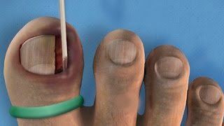 Ingrown Toenail Removal Surgery [upl. by Calloway]