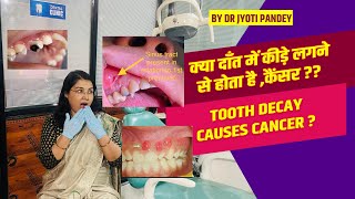 क्या दाँत में कीड़े लगने से होता है कैंसर  Is tooth decay causes CANCER [upl. by Elsey]