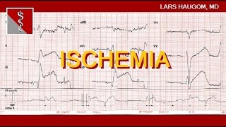 ECG Ischemia [upl. by Nitnerb]