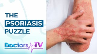 Psoriasis Know the Symptoms Causes and available Treatments from Dermatology Specialist [upl. by Ymmor]