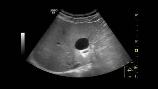 Hepatic cyst liver Rt lobe [upl. by Aicilak459]