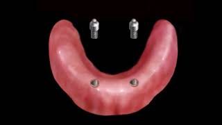 Proteza overdenture na 2 implantach [upl. by Isyed]