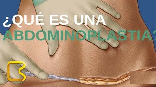 ¿Qué es una abdominoplastia [upl. by Enelyar950]