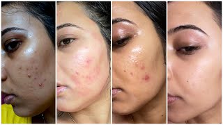 My Detailed 7 Days Nighttime Skincare Routine to remove Pimples Acnes Pimple Marks Dark Spots [upl. by Onilecram499]