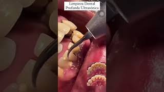 LIMPIEZA DENTAL CON ULTRASONIDO [upl. by Ynattib534]