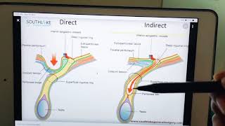 direct vs indirect inguinal hernia [upl. by Natassia]