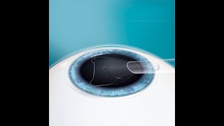 ICL Implantable Collamer Lens ICL Implant surgery implantable contact lens Visian [upl. by Irat]