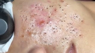 Treatment of Blackheads and Hidden Acne at Sac Dep Spa 130 [upl. by Irish]