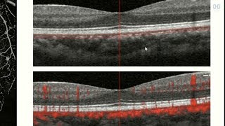 OCT Angiography Revolutionizing Vitreoretinal Disease [upl. by Coe]