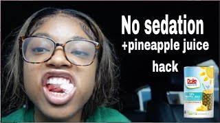 4 Wisdom teeth removed in 1 Day I Recovery Vlog Pineapple juice [upl. by Aix45]