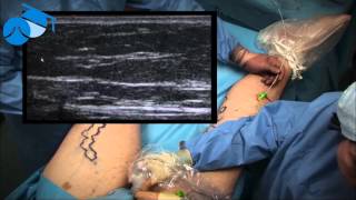 Endovenous Laser Ablation EVLA of Great Saphenous Vein  varicose veins [upl. by Sokim]