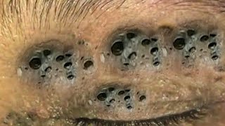 Big Cystic Acne Blackheads Extraction Blackheads amp Milia Whiteheads Removal Pimple Popping  5286 [upl. by Brear]