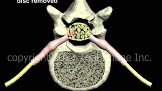 Lumbar Discectomy disc removal and Fusion  Narration and Animation by Cal Shipley MD [upl. by Erhard]