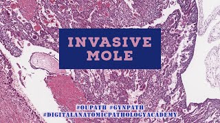 Invasive Hydatidiform Mole [upl. by Aliam523]