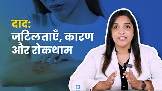 दाद जटिलताएँ कारण और रोकथाम [upl. by Anoyet]