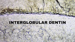 Interglobular dentin  Hypomineralized dentin  Dentistry Oral Histology 🔬 [upl. by Lorollas]