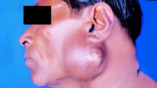 Tuberculous Abscess of Parotid Gland [upl. by Alvera]