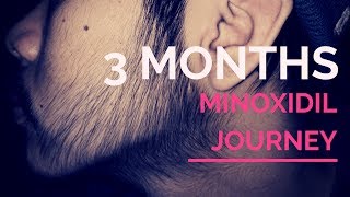 Week 12 Minoxidil Beard Journey [upl. by Enirehtahc289]