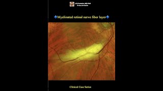 Myelinated retinal nerve fiber layer [upl. by Huldah]