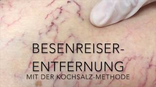 BesenreiserEntfernung mit der KochsalzMethode [upl. by Marijane]