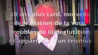 TRISMUS  1  Limitation de louverture buccale postradique [upl. by Yim]