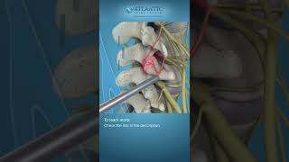 What is Endoscopic Facet Rhizotomy Shorts [upl. by Trinl]