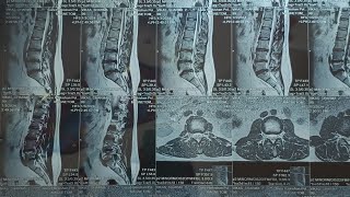 Always be happy L4 L5 S1 Disc bulgeDisc decompression lower back surgery Disc Break after surgery [upl. by Ycnay]