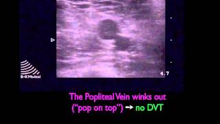 5 Ultrasound Deep Vein Thrombosis [upl. by Isoj619]