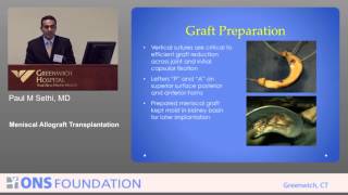 Meniscal Allograft Transplantation  Paul Sethi MD [upl. by Beilul]