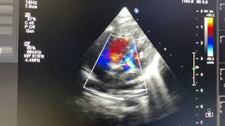 D transposition of great arteries [upl. by Weir]