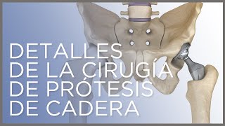 Detalles de la cirugía de prótesis de cadera Dr Ángel Villamor [upl. by Curkell815]